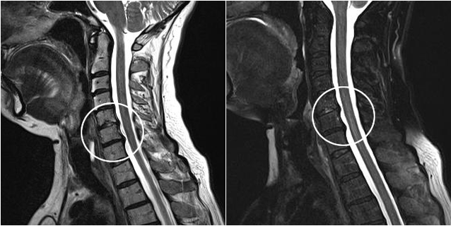 Emakakaela osteokondroos MRI-pildil